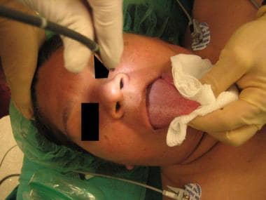 Tongue is grasped by an assistant. Endotracheal tu