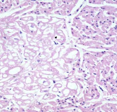 Rhabdomyoma is seen at left side of image. Cells a