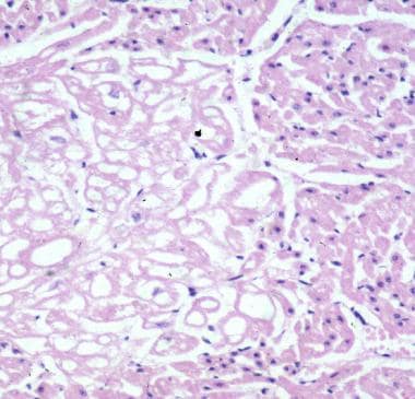 Cardiac Rhabdomyoma Pathology: Definition, Epidemiology, Etiology