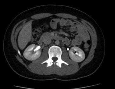 CT urogram utilizing a split dose technique: Axial