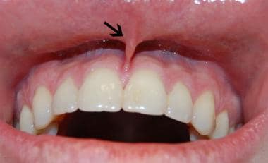 Upper vestibule (upper lip everted). Arrow indicat
