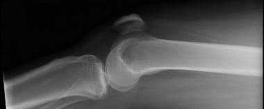 Lateral radiograph of patella with knee in near ex