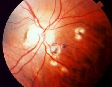 Peripapillary scars secondary to toxoplasmosis. 