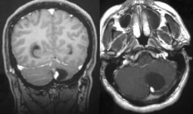 Coronal and axial T1-weighted gadolinium-enhanced 