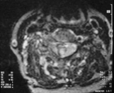 Axial T2-weighted MRI shows a mixed-intensity lesi