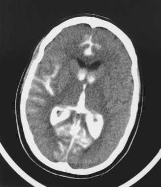 A computed tomography scan obtained after angiogra