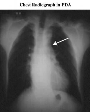 Frontal chest radiograph in a patient with patent 