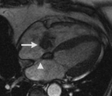 Lipomatous hypertrophy of the interatrial septum: 