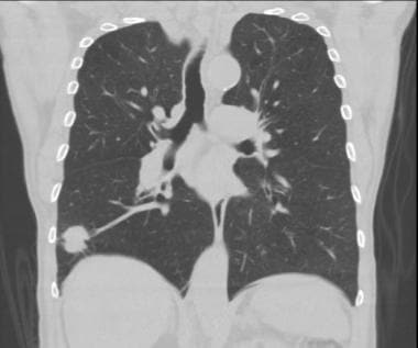 CT scan in patient with rectal carcinoma and liver