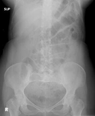 Mesenteric ischemia. Plain abdominal radiograph in