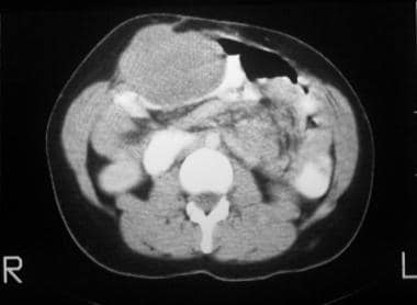 A CT scan of a 36-year-old woman with Gardner synd