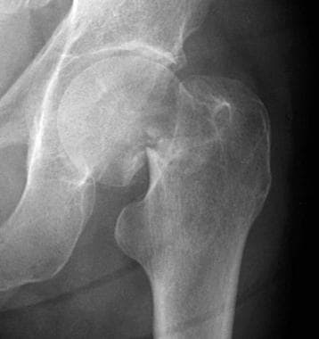 Radiograph depicting a Garden IV hip fracture. 