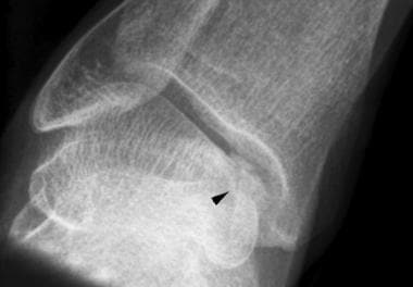 Anteroposterior radiograph of the leg reveals oste