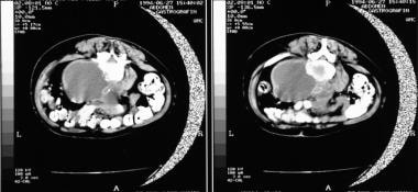 Osteomyelitis, chronic. CT scans show vertebral os