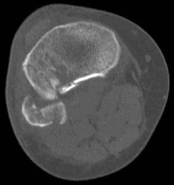 Tibial plateau fractures. Axial CT image through t