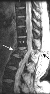 Thoracic spine trauma. Gradient-echo T2-weighted s