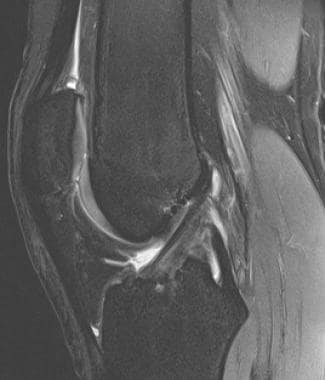 Normal anterior cruciate ligament (ACL) in sagitta