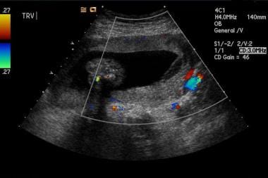 Marginal placental hemorrhage: Color Doppler flow 