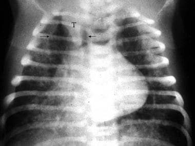 Meconium aspiration. Radiographic findings in a mo
