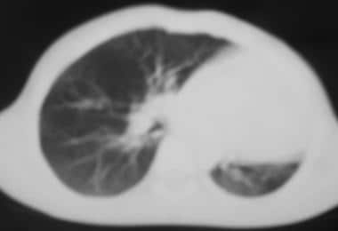 Computed tomography scan showing pulmonary hypopla