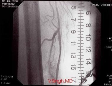Angiogram obtained after percutaneous transluminal