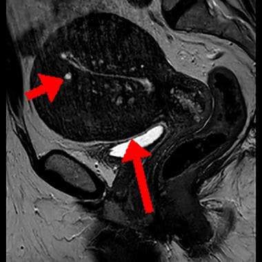 Sagittal T2-weighted MRI image (same patient as in