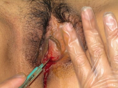 Incision of Bartholin abscess. 
