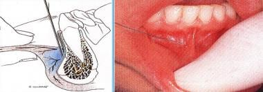 Insertion of needle in mucobuccal fold for infiltr