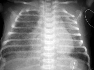 Severe persistent pulmonary hypertension in a neonate with