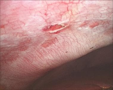 Laparoscopic cholecystectomy. Removal of ports und