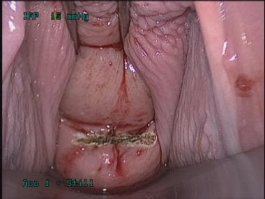 Transvaginal cholecystectomy. Incision for entry i