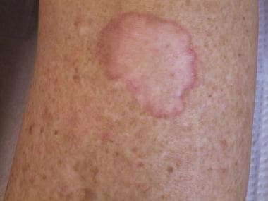 Porokeratosis of Mibelli on the lower leg in a ren