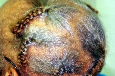 Traction alopecia. 