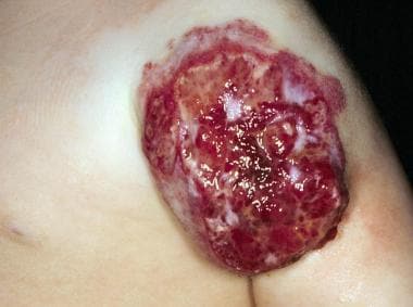 Exquisitely painful ulcerated mixed hemangioma (su