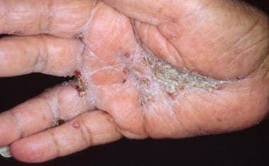 Bazex syndrome. Acquired palmar keratoderma in a w