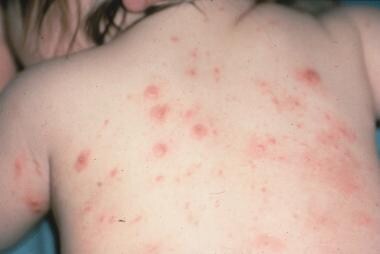 Widespread eruption on the back of an infant with 