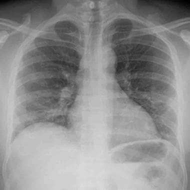Chest radiograph PA view demonstrates bilateral lo