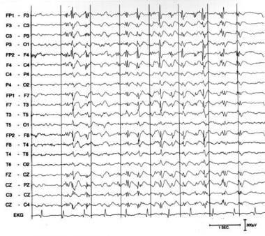 Slow spike wave pattern in a 24-year-old awake mal