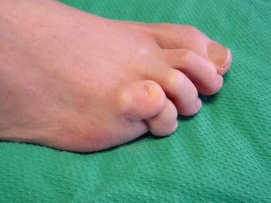 Fifth-toe deformities. This image and image below 
