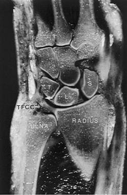 Triangular fibrocartilage complex suspends distal 