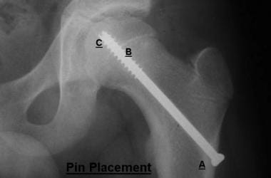 Pin placement (anteroposterior view). A: The entry
