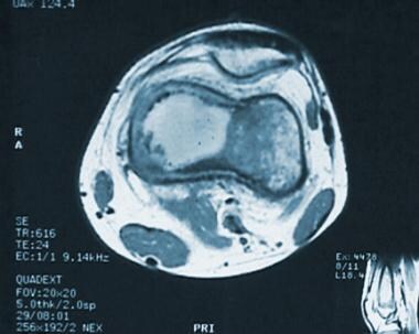 Magnetic resonance image (MRI) of low-grade centra