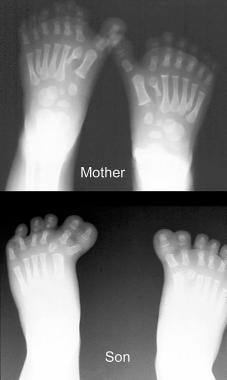 Mother and son with polydactyly. The patterns of d