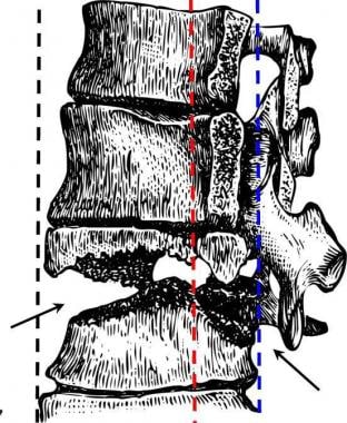 Lumbar Compression Fracture: Practice Essentials, Pathophysiology