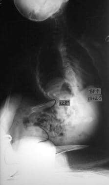 Neuromuscular scoliosis. Preoperative anteroposter