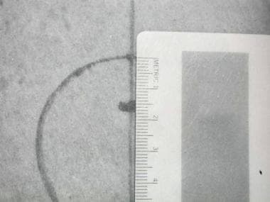 Positioning nipple 1-2 cm below caliper-measured d