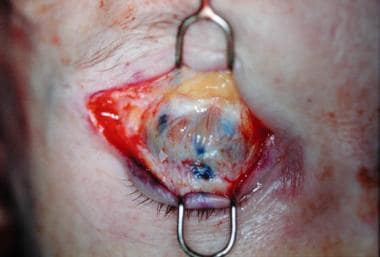Blepharoplasty, upper lid ptosis surgery. Intraope