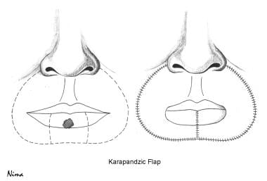 Karapandzic flap technique. 