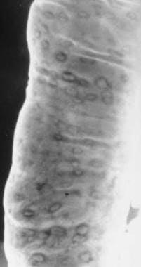 Crohn disease. Aphthous ulcers. A double-contrast 