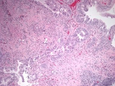 Inflammatory bowel disease. Histologic section fro